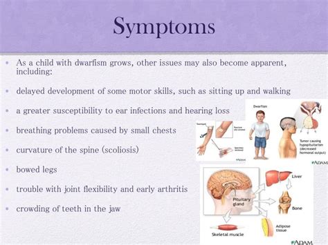 PPT - Dwarfism PowerPoint Presentation - ID:1885711