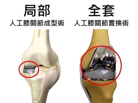 民正新聞記者:蔡永源報導成大醫院關節重建戴大為醫師-膝關節貼磁磚治療退化更簡單 - YouTube