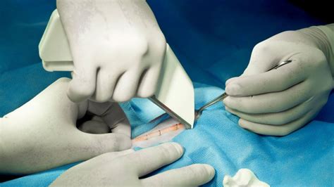 An In-depth Guide to Surgical Staples: Types, Uses, & Usage