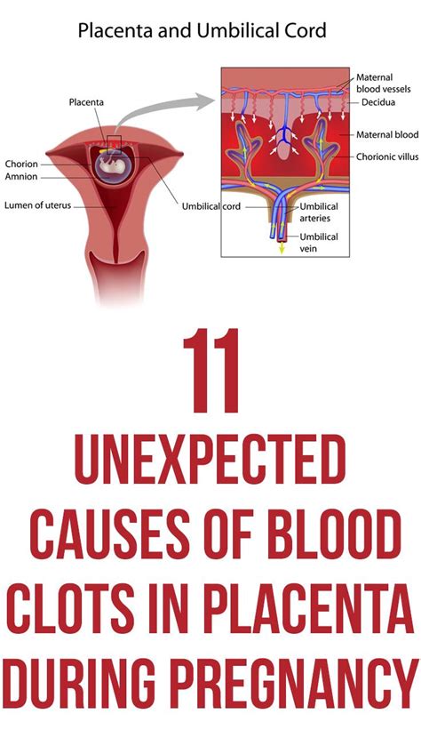 How To Prevent Blood Clots In Placenta During Pregnancy at Stephen Hill blog