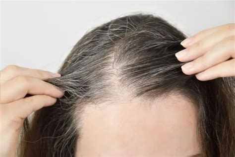 What is Telogen Effluvium and How Should You Treat it? 2022 - Hair Loss Geeks