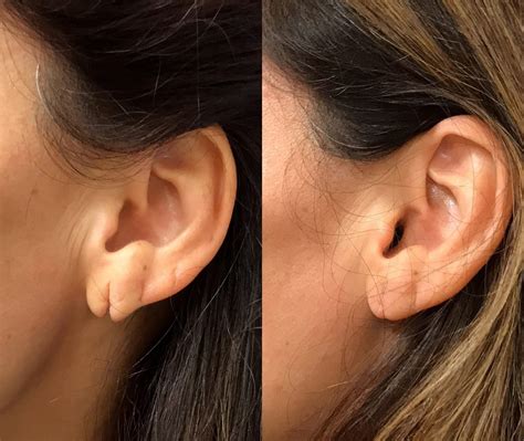 Before & After Photos Earlobe Repair 3 | NYC