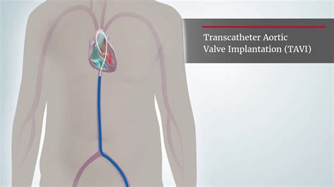 Aortic Stenosis | TAVI procedure - YouTube