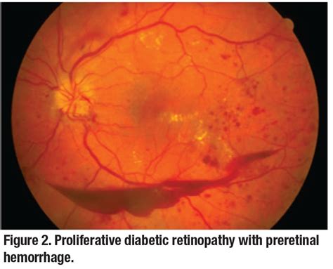 Clinical trial lessons for managing diabetic retinopathy