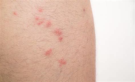 How to Identify Common Bug Bites