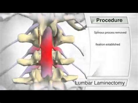 Lumbar Laminectomy Procedure - YouTube