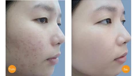 A Permanent Cure for Acne Scars