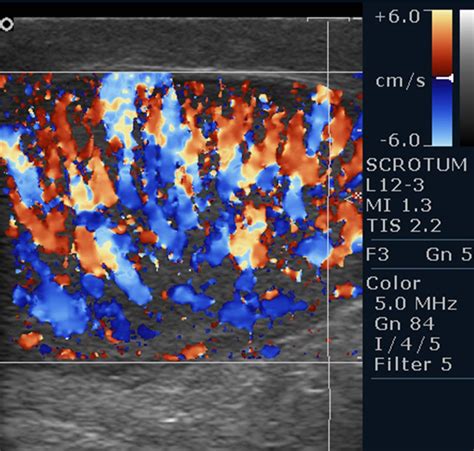 Inferno: colour Doppler ultrasound sign of orchitis | BMJ Case Reports