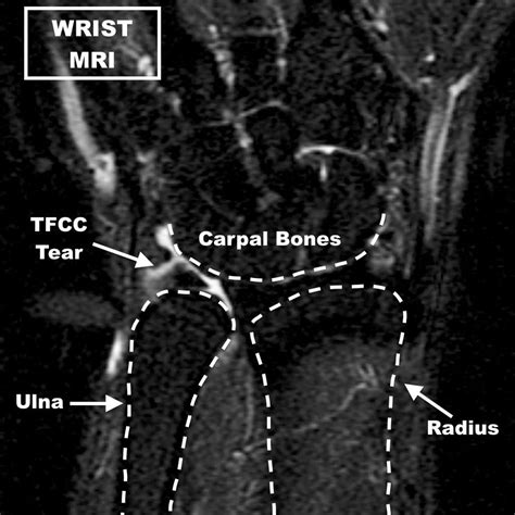 TFCC (Wrist Cartilage) Tear