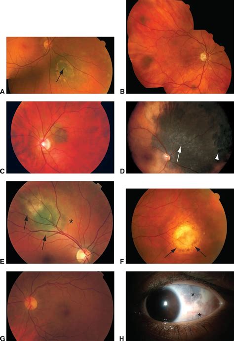 Choroidal nevi - American Academy of Ophthalmology