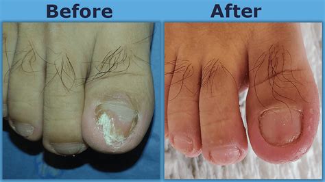 Risks You Can Avoid by Choosing Laser Fungal Nail Treatment in London