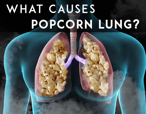 Vape King Blog: The Truth about Popcorn lung