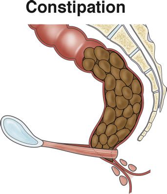 Constipation - Clinical Gastroenterology and Hepatology