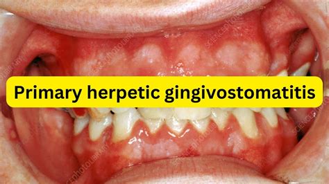 What is primary herpetic gingivostomatitis? - YouTube