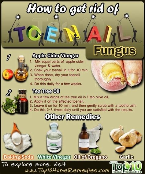 How to Get Rid of Toenail Fungus | Top 10 Home Remedies