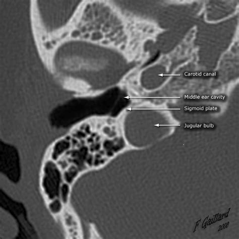 Sigmoid plate (diagram) | Radiology Case | Radiopaedia.org | Radiology, Medical school stuff ...