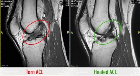 Can the ACL Spontaneously Heal After Rupture?