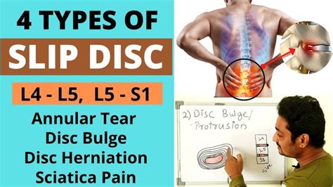 Slip Disc Herniation, Bulging Disc, Annular Tear, At L4-L5-S1 | Slip Disc Types | Sciatica Pain ...