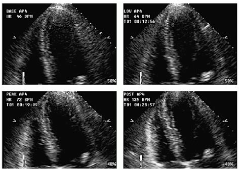 Stress Echocardiography | Thoracic Key