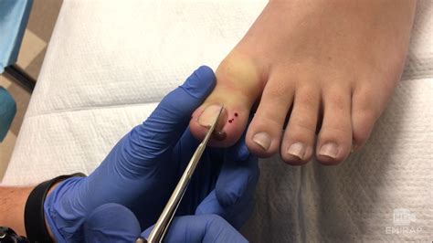 Ingrown Toenails: Causes, Symptoms, And Diagnosis, 44% OFF