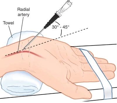 Arterial Line Placement: Basics for Medical Students EMRA