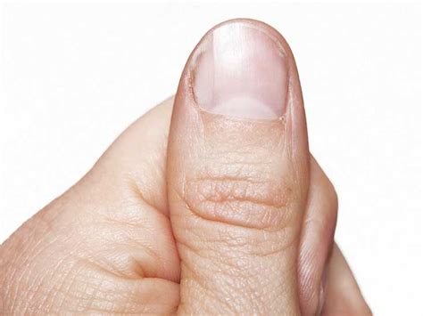 Nail Psoriasis: Pictures, Symptoms, and Treatments