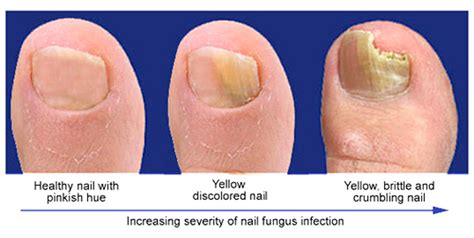 Proximal Subungual Onychomycosis