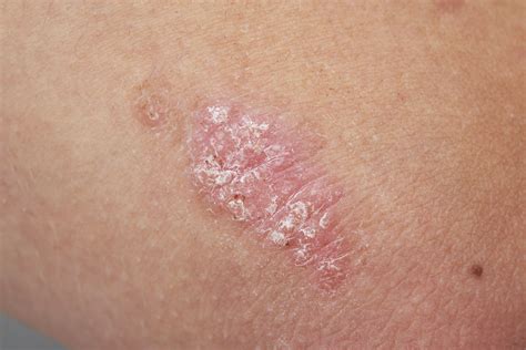 Overview of Psoriasis and Treatment Options