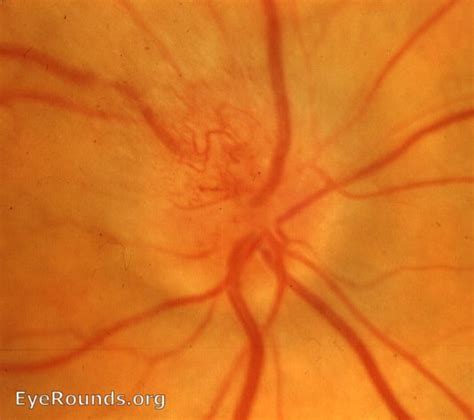 Atlas Entry - Non-arteritic anterior ischemic optic neuropathy (NAION)