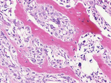 Osteosarcoma Histology Labeled