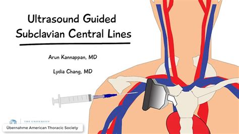 Subclavian Vein Central Line Anatomy