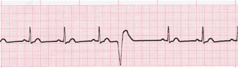 Premature Ventricular Complexes (PVC's) ECG Interpretation #315