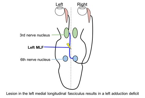 Internuclear ophthalmoplegia – Case-Based Neuro-Ophthalmology