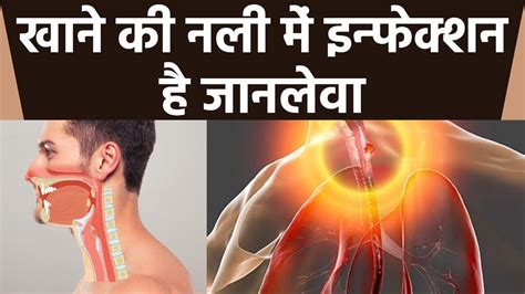 Food Pipe का Infection है बेहद खतरनाक । Expert से जानें इसके लक्षण और बचाव के उपाय । Boldsky ...