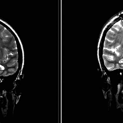 Pre-and post-operative MRI scans, T2 coronal images of the colloid cyst ...