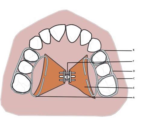 Hyrax Appliance Rapid Maxillary Expansion