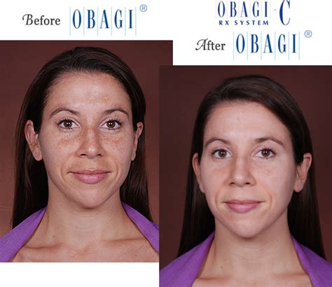 Obagi® Before and After Pictures – Micki Ly M.D. Maui Dermatologist