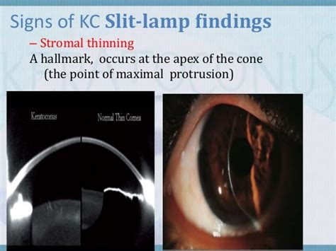 Rizzuti Sign Keratoconus