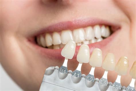 Versatile Veneers — The Ultimate Cover-Up: Modern Age Dentistry: Dentists