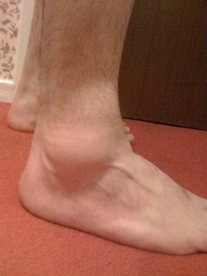 Enlarged Ankles: Causes and Treatments | MD-Health.com