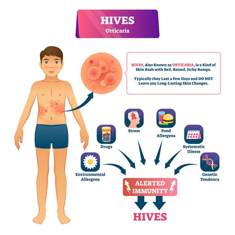 What is Urticaria or Hives? Learn the Causes & how to treat it.