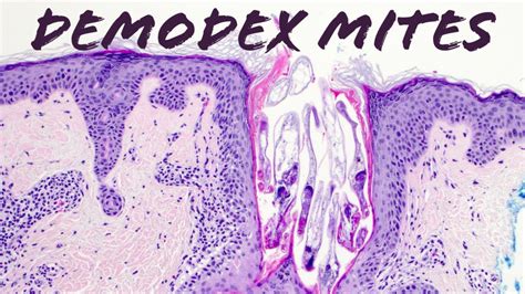 Demodex Mites under the microscope (Demodex folliculorum & Demodex ...