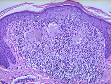 Lichen Sclerosis Histology