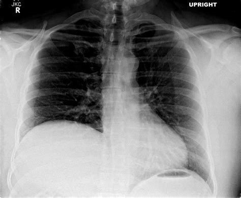 Differential Diagnosis of Elevated Hemidiaphragm