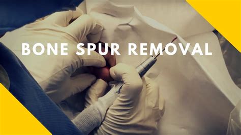 Ostectomy - Bone Spur Removal - YouTube