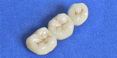 Choosing The Perfect Material For Your Dental Crown - Keep 28 Dental