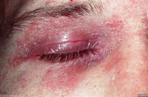 Eyelid Dermatitis Treatment Symptoms And Causes