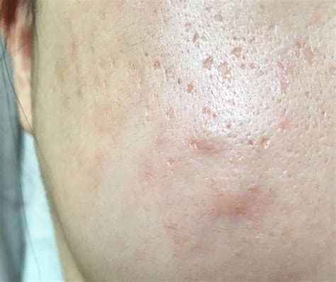 [acne] What to do about these huge under the skin bumps (Cyst? Nodule ...