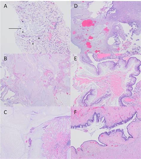 A. Omental biopsy section (H&E, 100×) showing acellular and organizing... | Download Scientific ...