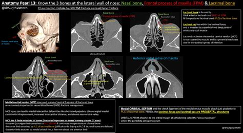 Frontal Process Of Maxilla Fracture